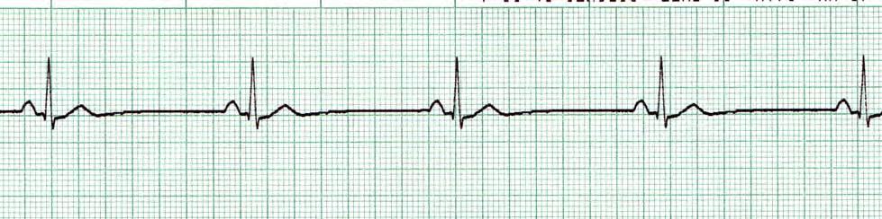 Sinus Bradycardia Sinus Bradycardia is a decrease in the rate of atrial depolarization subsequent to a slowing of the sinus node.