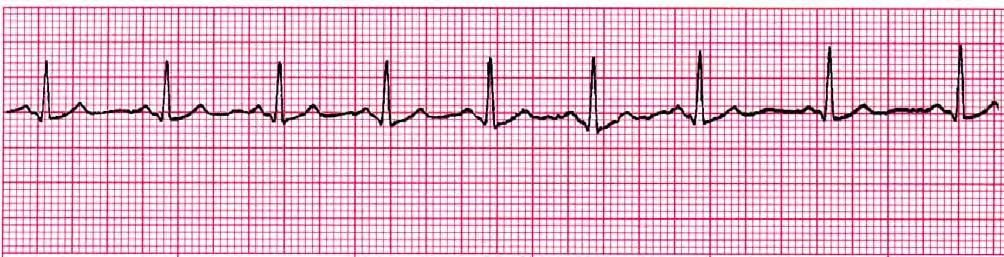 Normal in children, young adults & the elderly Coronary Artery Disease Medications Treatment: Assess patient to determine stability; 12-lead ECG, notify physician if new rhythm or unstable Generally