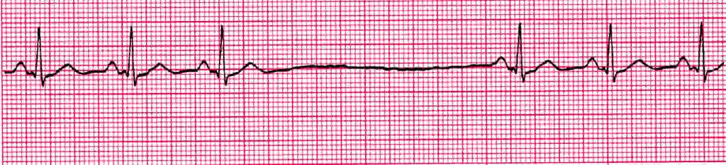 Normal Sinus Rhythm with a 2.44 Second Sinus Pause. R R = Before and After Pause Sinus Arrest interval = Measure from the start of the P before the pause to the start of the P after the pause = 2.