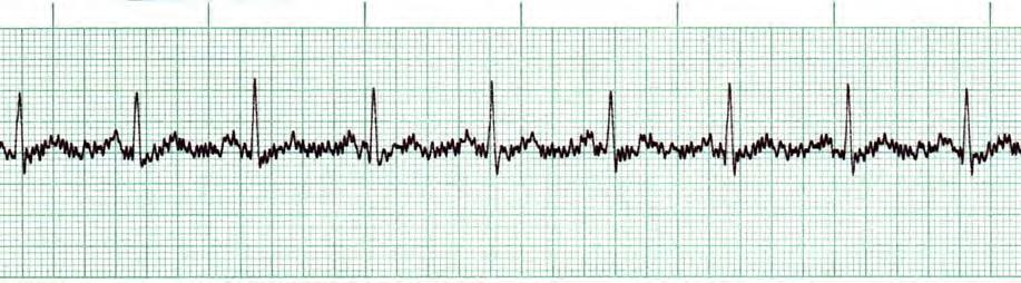R P T Normal Sinus Rhythm with Artifact Documentation & Housekeeping The monitor ECG strip should be placed in the Nursing and Allied Health Professions Notes.