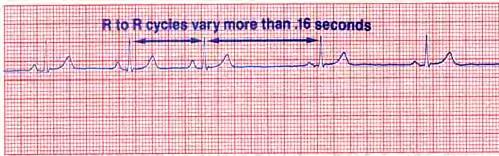 peaked or notched; may be buried in preceding sinus T wave; PRI may be