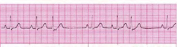 10 Rate: 150 bpm Supraventricular Not visible Tachycardia (SVT) PRI:
