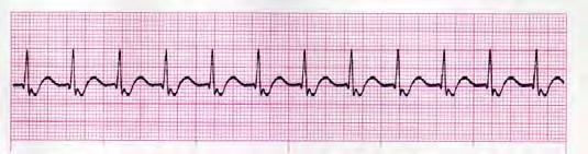 10 Rate: 61-100 bpm Rhythm: R Junctional Tachycardia PRI: 0.