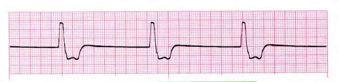 Tachycardia None PRI: N/A >0.