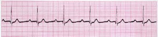 rhythm that should perfuse but patient is PULSELESS = Rhythm Name with PEA 1 st degree AV Block Round,