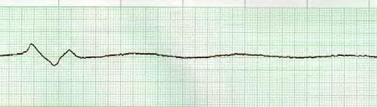 10 Only block that does not drop qrs Consistent PRI 2 nd degree AV Block, Type II P:qRs 1:1 Round,