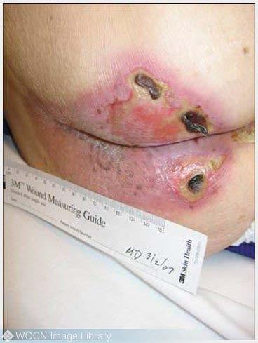 Snap Review: A Bit More on Category/Stage II Stage II presents as a shiny or dry shallow ulcer without slough or bruising.