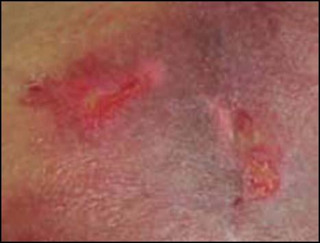 Snap Review: Category/Stage II Partial-thickness loss of dermis presenting as a