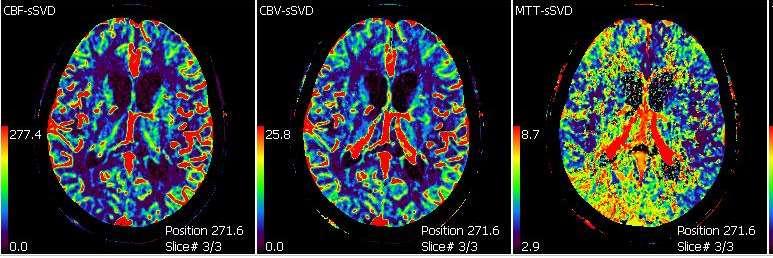 Perfusion CT 13 days later CBF CBV MTT CT perfusion images