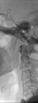 Carotid artery stenting 62 M Pre PTA 1 st stent 2