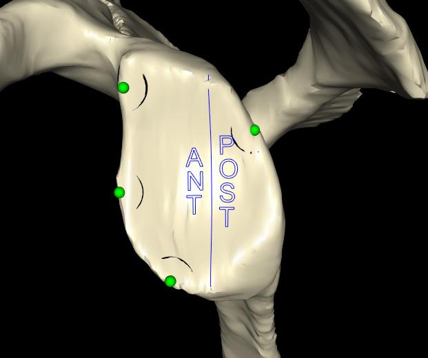 Figure 1 PSI GUIDE CREATION AND ORDER When the glenoid implant positioning is set and a patient specific guide is desired, select the blue Continue button in the lower right corner of the screen