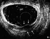 When intrarectal gel is employed the two muscle layers are seen projecting into the rectal lumen Scan 4.