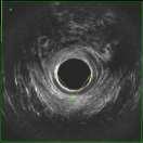 evacuation of stools Sensation of anorectal obstruction Manual disimpaction of stool, or
