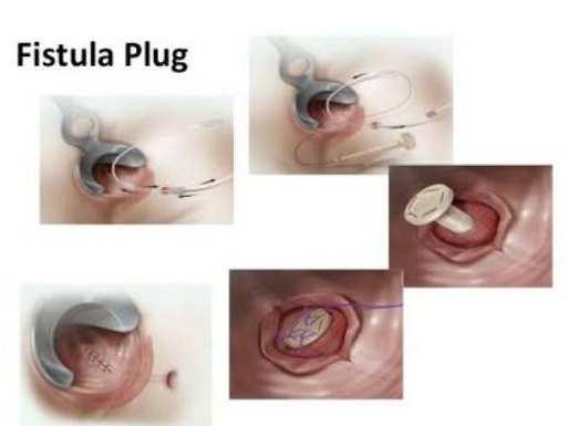 It is cone shaped bioprosthetic plug made from porcine small intestine submucosa, introduced by Armstrong. Procedure can be performed under local, regional and general anesthesia.