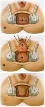 Figure 10: Fistulotomy Figure 9: Endo rectal flap 6.