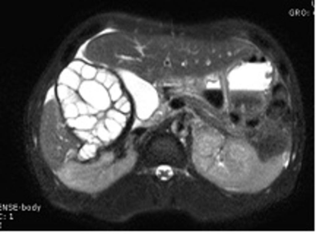 Fig. 5: Axial fat-suppressed T2-weighted MR image that shows a wall rupture