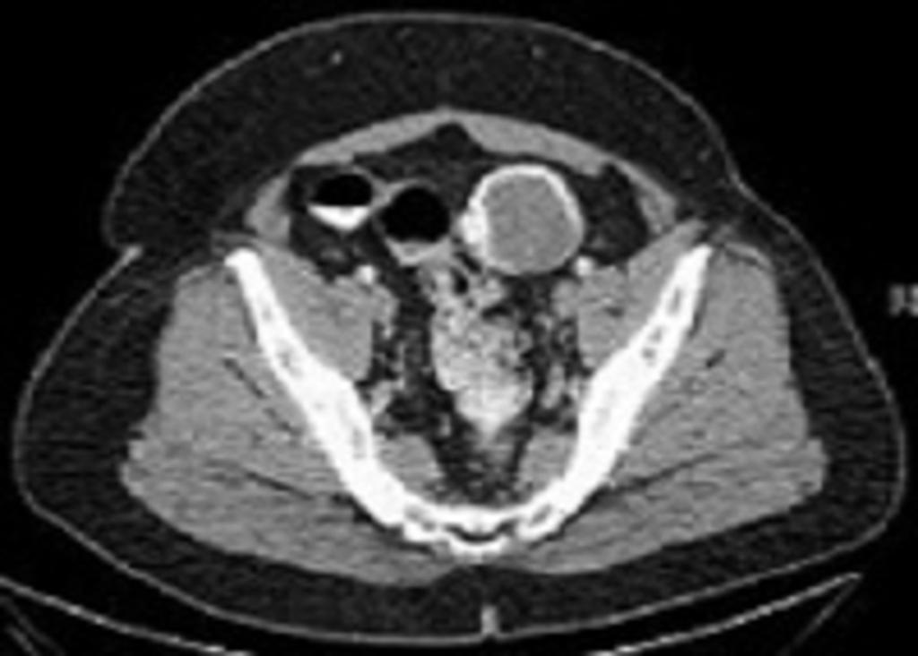 Fig. 8: Contrast-enhanced abdominal CT scan demonstrates a