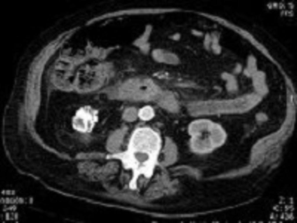 Fig. 9: Contrast-enhanced abdominal CT scan.