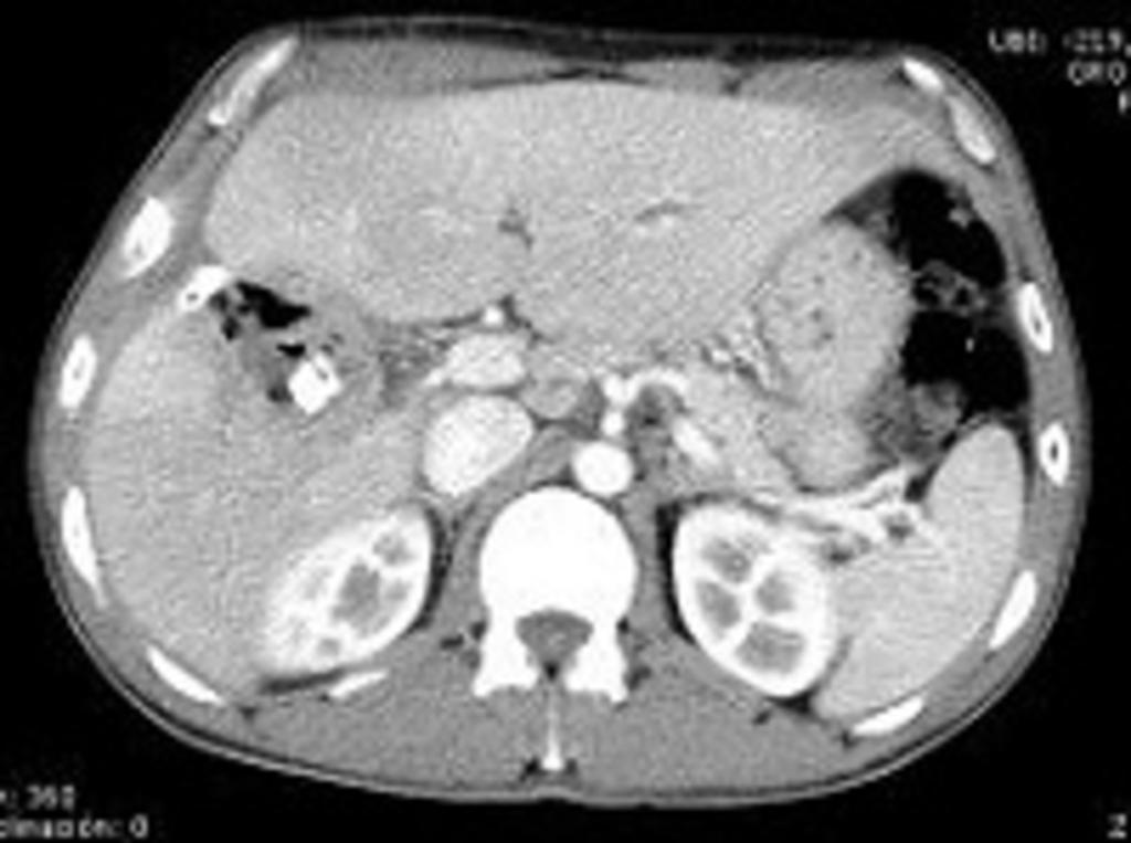 Fig. 12: Contrast-enhanced abdominal CT scan.