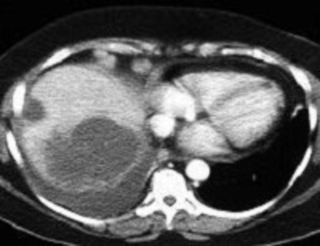 Fig. 13: This Contrast-enhanced abdominal CT scan demonstrates an