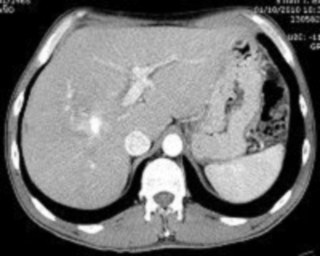 Fig. 14: Contrast-enhanced abdominal CT scan (arterial phase).