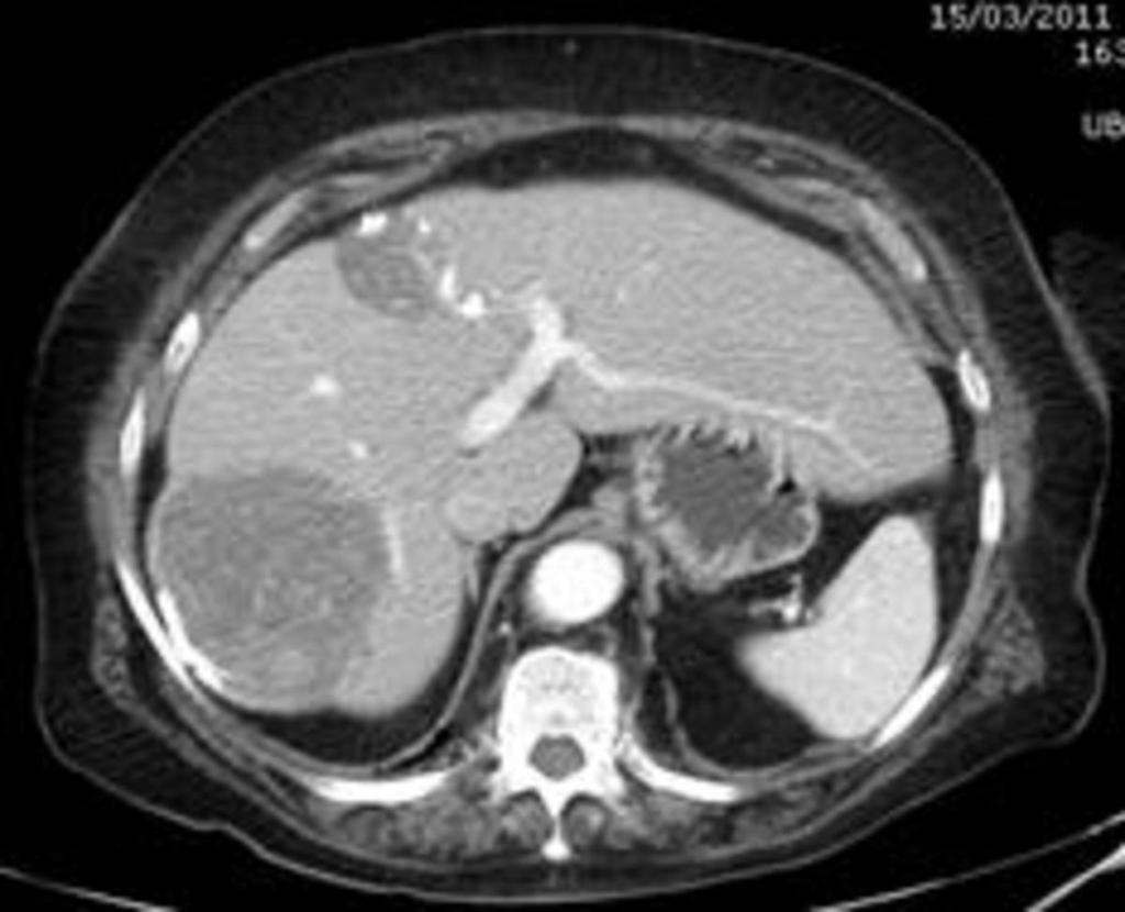 Fig. 2: Enhanced abdominal CT scan in arterial fase that shows two defined