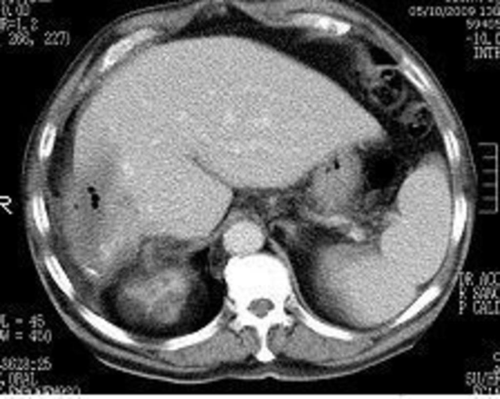 Fig. 3: Enhanced abdominal CT scan that shows a poorly defined cyst with air