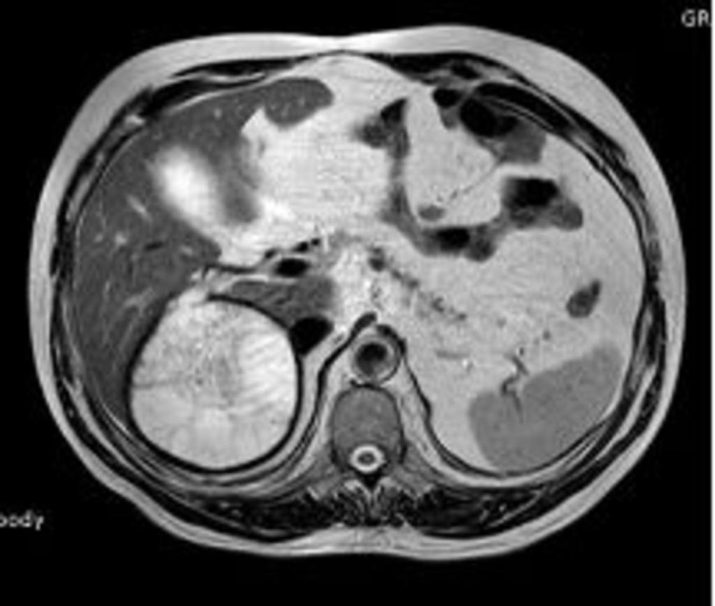 Fig. 4: Axial T2 weighted MR of the liver that shows Wall rupture with fistula of