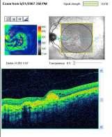 Macular Change Analysis Ongoing Dry AMD/ Geographic Atophy Studies Documenting