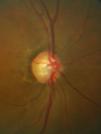 Cirrus OCT Glaucoma Updates Advanced GPA for