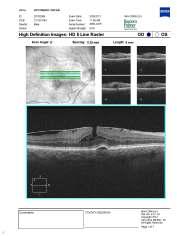 inner from the outer foveal layers, leading to an intraretinal split Absence of a full