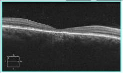 54 y/o Hisp Male VA RE X 10 Yrs 20/400 20/20 Plaquenil Screening: Traditionally Baseline macula photos Color vision testing Amsler grid 10-2 Visual fields Yearly exams