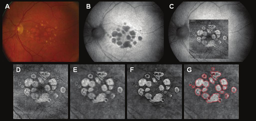 Figure 4. Right eye of an 83-year-old man with unifocal geographic atrophy (GA) imaged using different modalities and measured using both manual and automated techniques.