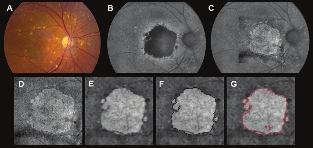 (C), OCT fundus image (area = 14.38 mm2) (D), and sub-rpe slab image (E). The boundaries of GA were manually outlined on the sub-rpe slab image with the area of GA measured to be 14.61 mm2 (F).