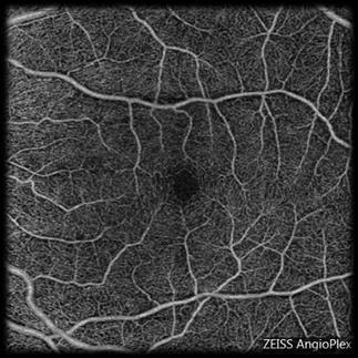 Traditional Angiography Images OCT Angiography (OCTA) Images OCT Angiography (OCTA) Images new AngioPlex