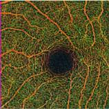 AngioPlex Maps AngioPlex Maps consists of a 2D representation of retinal the