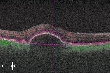 maps and allows for depth visualization of retinal blood flow.