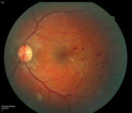 Avascular region of the retina in healthy eyes.