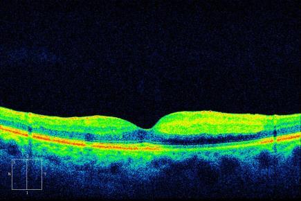 Interpretation of OCT Differentiate between inner and outer retinal disease as first step.