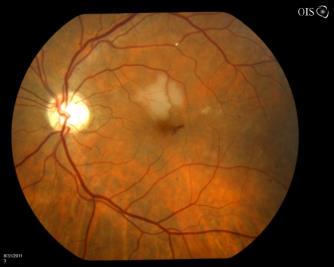 Outer retina Disease of the photoreceptors Disease of the RPE AMD, CSR and dystrophic disease 73 year old man with a new scotoma OS