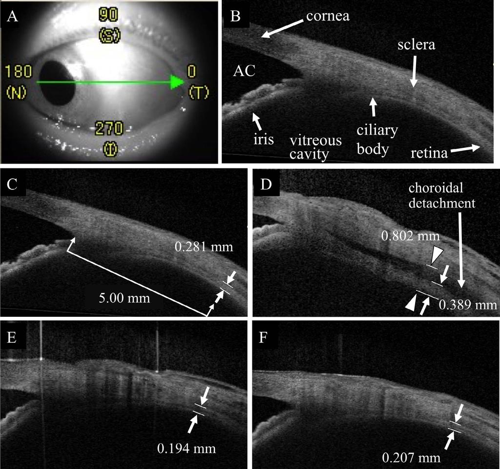 Changes in the Peripheral Retinochoroidal Thickness IOVS j May 2015 j Vol. 56 j No. 5 j 3035 FIGURE 1. Representative AS-OCT images of eyes with proliferative diabetic retinopathy (PDR).