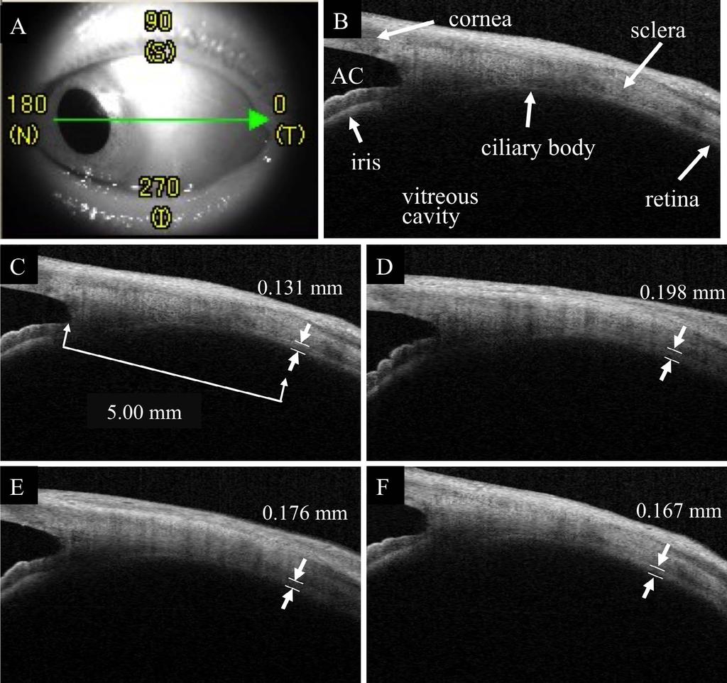 Changes in the Peripheral Retinochoroidal Thickness IOVS j May 2015 j Vol. 56 j No. 5 j 3036 FIGURE 2. Representative AS-OCT images of eyes with an ERM.