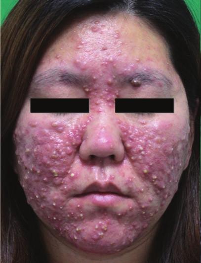 Rosacea fulminans associated with pregnancy 123 after delivery.