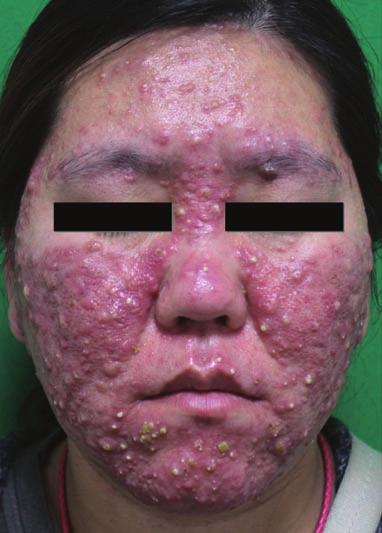 During 18 months of follow-up, there was no sign of recurrence. Discussion Rosacea fulminans is considered to be a rare and extreme form of rosacea.