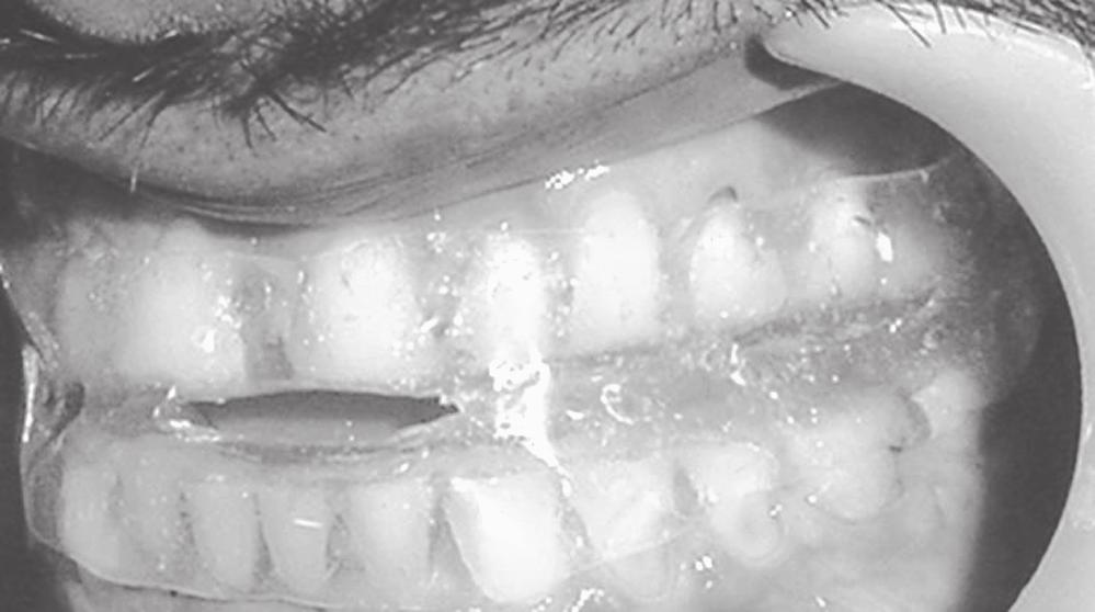 Oral appliances prescribed were Karwetzky activator (KZY), mandibular advancement splint (MAS), tongue retaining device (TRD) and Herbst appliance (HST) (Fig.