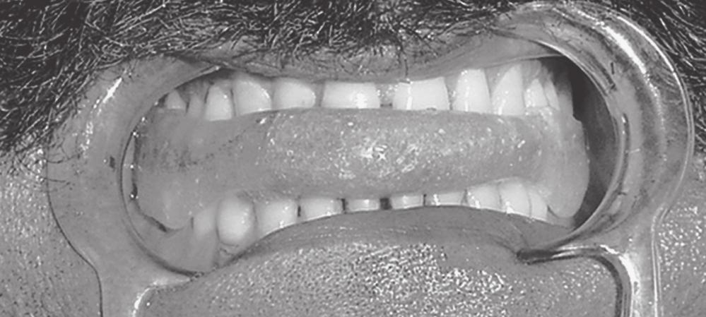 During bite recording the mandibular advancement did not exceed 70% of the maximum protrusion. Vertical opening did not exceed 3-4 mm beyond free way space.