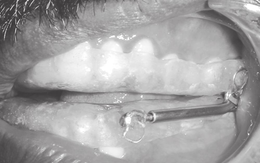 PSG with oral appliance was performed only after the patient reported subjective improvement and was performed after 3-4 weeks of use. The patients were asked to use oral appliance only in the night.