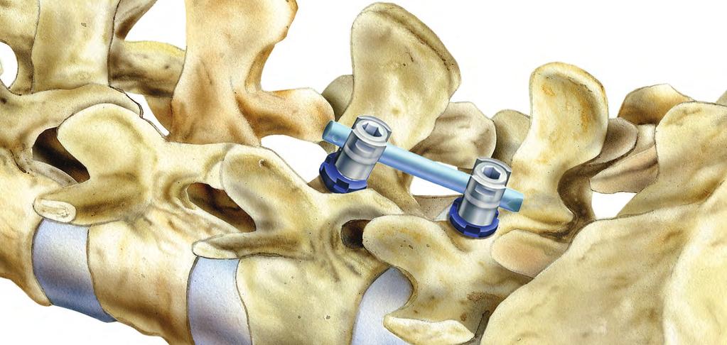 SECURIS Pedicle Screw System for Minimally Invasive Surgery Securis Pedicle Screw