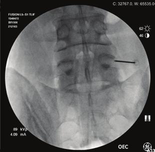 Insert the Guidewire [119001] through the Bone Access Needle, using the cannulated access of the t-handle. Confirm placement of the Guidewire using fluoroscopy.