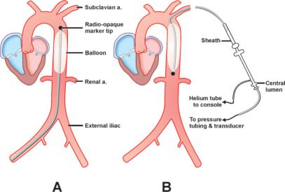 IABP Percutaneously placed via the femoral artery or left axillary artery (7 to 8 French) Placed in the descending thoracic aorta Can be